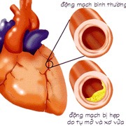 Nhồi máu cơ tim do xơ vữa động mạch