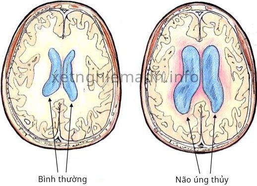 Giãn não thất ở thai nhi – Não úng thủy — iDNA